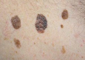 SEBORRHEIC KERATOSIS contraindications In beauty therapy