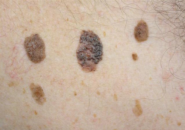 SEBORRHEIC KERATOSIS contraindications In beauty therapy