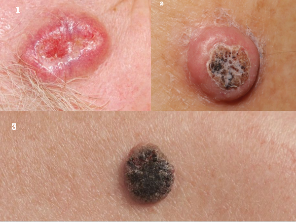 SKIN CANCER contraindications In beauty therapy