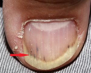 SPLINTER HEMORRHAGE contraindications In beauty therapy