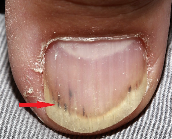 SPLINTER HEMORRHAGE contraindications In beauty therapy