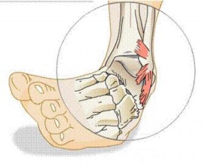SPRAINS contraindications In beauty therapy