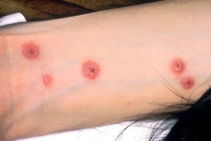 STEVENS-JOHNSON contraindications In beauty therapy