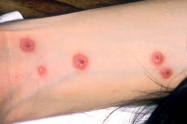 STEVENS-JOHNSON contraindications In beauty therapy