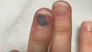 SUBUNGUAL HEMATOMA contraindications In beauty therapy