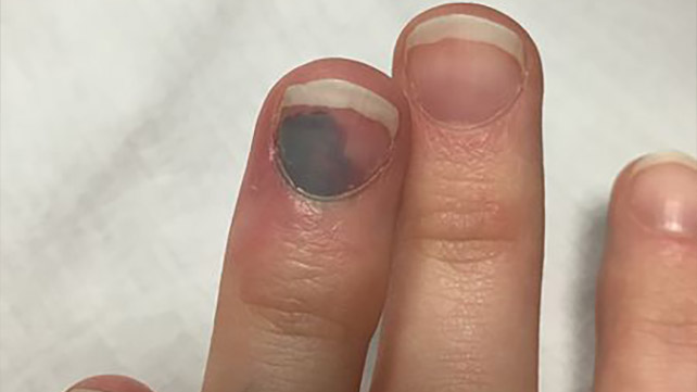 SUBUNGUAL HEMATOMA contraindications In beauty therapy