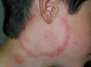TINEA BARBAE (TINEA FACIEI) contraindications In beauty therapy