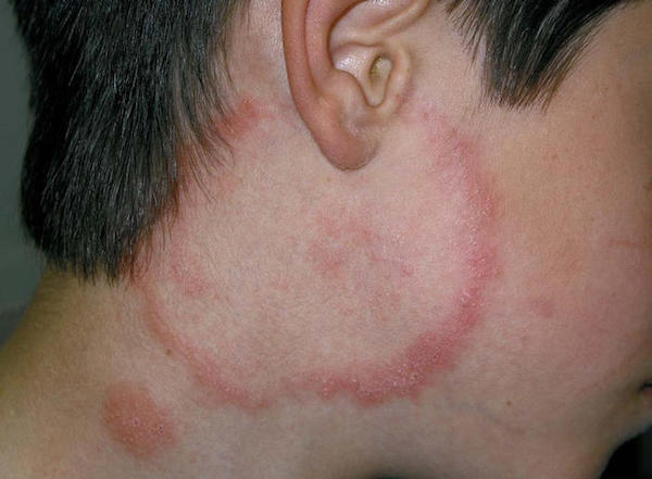 TINEA BARBAE (TINEA FACIEI) contraindications In beauty therapy