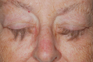 TRICHOMEGALY contraindications In beauty therapy