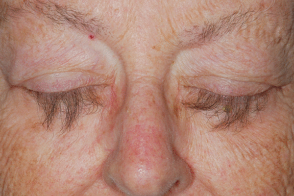 TRICHOMEGALY contraindications In beauty therapy