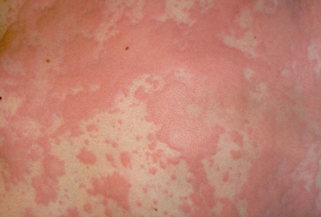 URTICARIA (HIVES) contraindications In beauty therapy