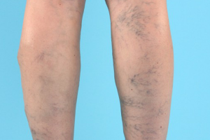 VARICOSE VEINS contraindications In beauty therapy