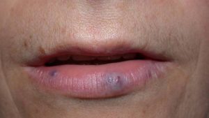 VENOUS LAKE contraindications In beauty therapy
