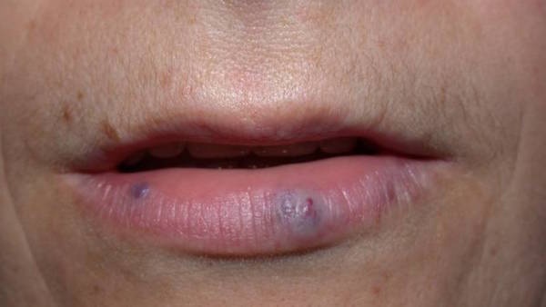 VENOUS LAKE contraindications In beauty therapy
