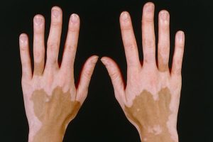 VITILIGO contraindications In beauty therapy