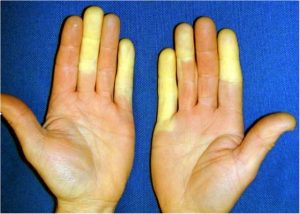 ANAEMIA (ANEMIA) contraindications In beauty therapy