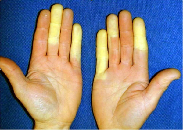ANAEMIA (ANEMIA) contraindications In beauty therapy