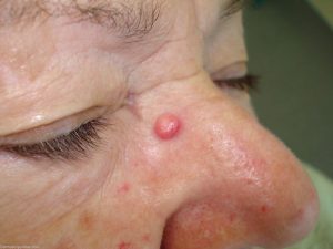 ANGIOFIBROMA contraindications In beauty therapy